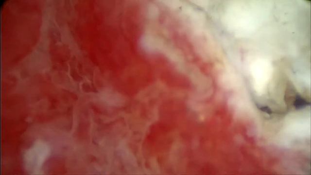 2019 01 29 Гістерорезектоскопія. Видалення субмукозного вузла. смотреть онлайн