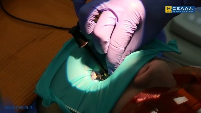 Апекслокатор BINGO PRO (Бинго Про) для стоматологов. Пошаговая инструкция по применению