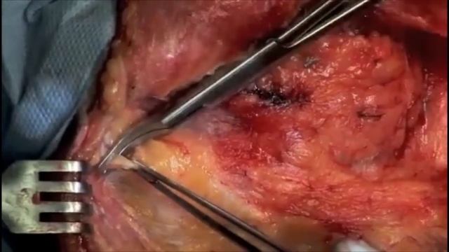 Modified Radical Neck Dissection Part I. Dr John M Chaplin, Auckland , New Zealand смотреть онлайн