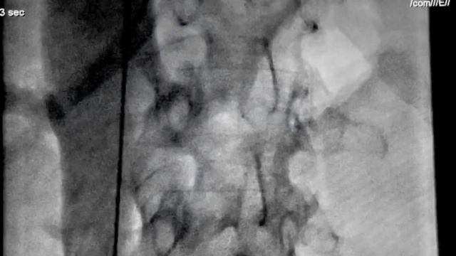 IVC filter implantation technique step by step смотреть онлайн