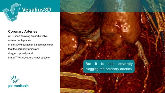 Vesalius3D - Demo Coronary Arteries смотреть онлайн