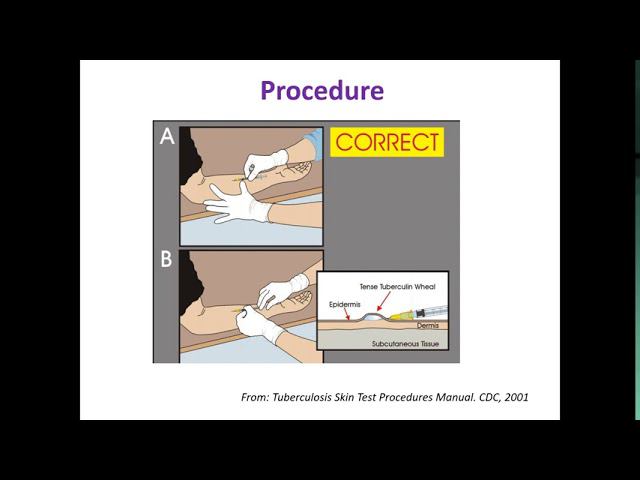 Immunological Diagnostics Of Tuberculosis