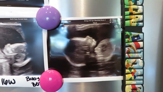 20 Week Pregnancy Update // Anatomy Scan and Trisomy 13 Update смотреть онлайн