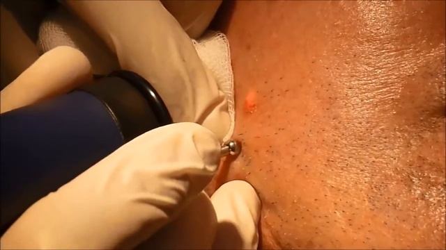 MCL31 Dermablate. эрбиевый лазер для удаления пигментных пятен смотреть онлайн