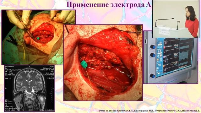 Пахомова Н.В. Реабилитация при поражении лица