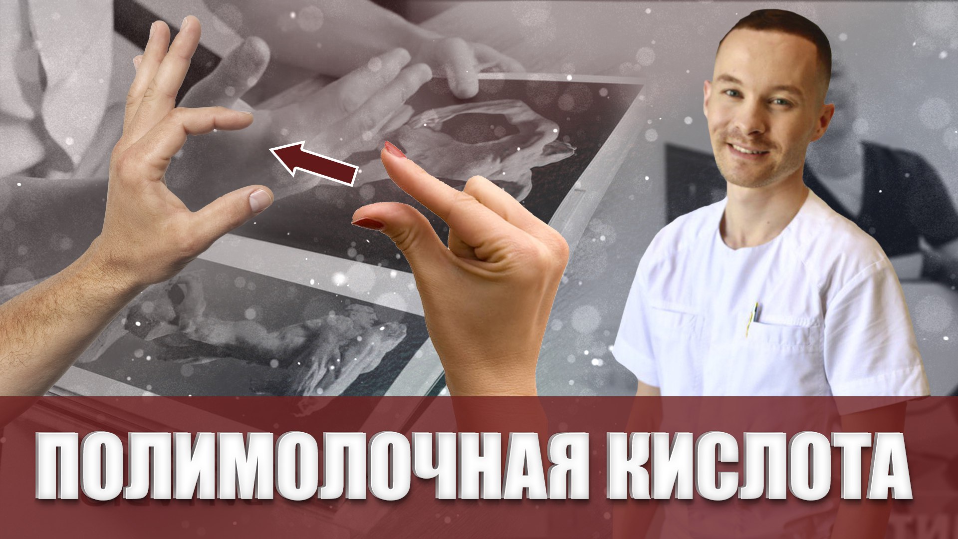 Утолщение члена полимолочной кислотой