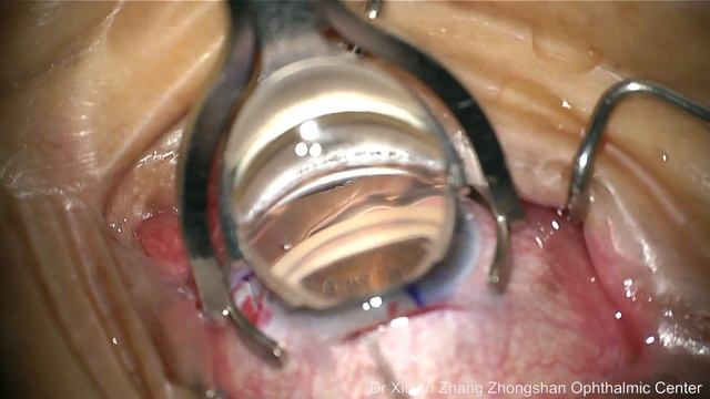 200.SPI+GSL+GT for uncontrolled IOP following argon laser peripheral iridoplasty смотреть онлайн