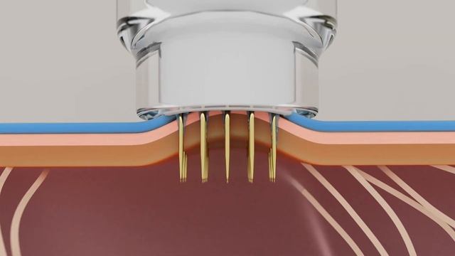 RF аппарат Potenza с наконечником Fusion смотреть онлайн