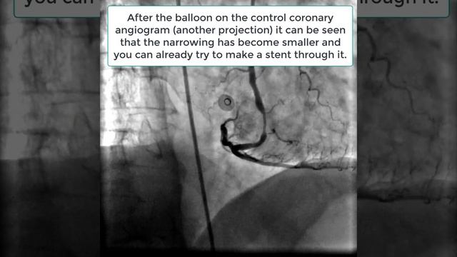100 percent blockage right coronary artery. The left coronary artery is normal. смотреть онлайн