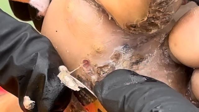 Jigger digging Fred Osumba - see full video @riseupsociety.net смотреть онлайн