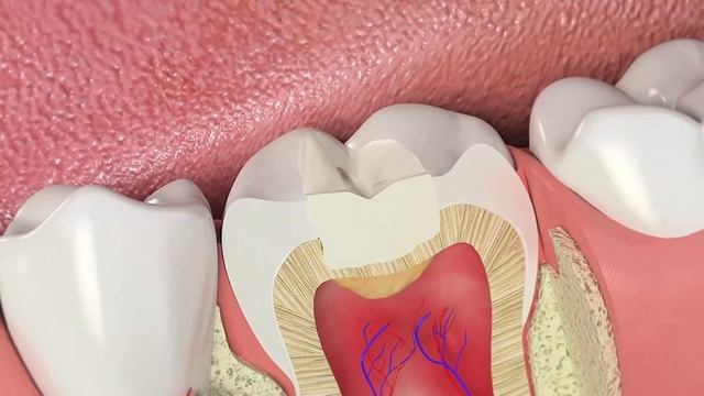 Сколько можно ходить с временной пломбой? | InSmile | Глеб Пекли смотреть онлайн