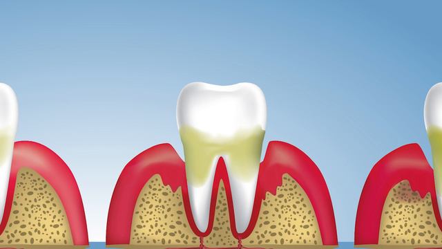 Diş Eti Hastalığının Aşamaları Nelerdir? | Gingivitis ve Periodontitis | Diş Eti Hastalıkları-03 смотреть онлайн