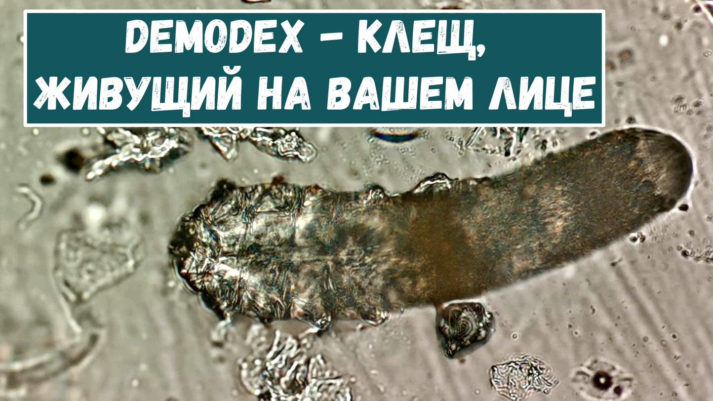 Лицевой клещ - Demodex смотреть онлайн