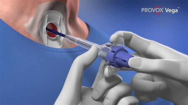 Helping Restore Speech After Laryngectomy: Complete Guide To Provox Vega Voice Prosthesis Insertion