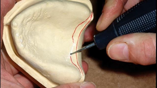 Top Denture Suction HAMULAR NOTCH Explained смотреть онлайн