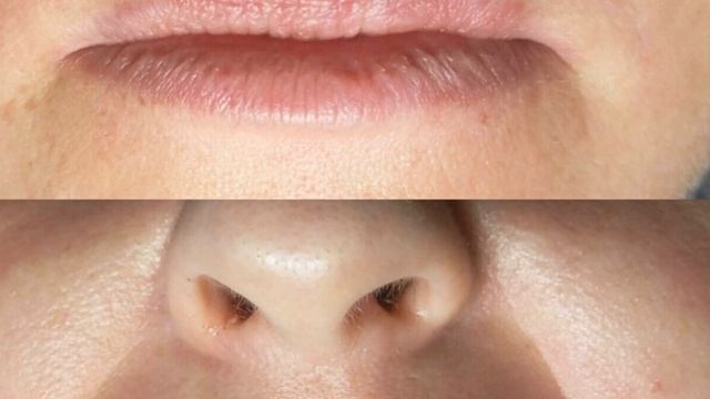 Как убрать носогубные складки смотреть онлайн