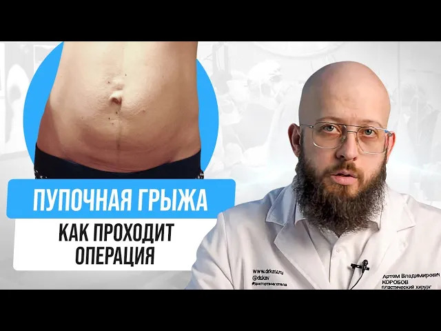 Операция по удалению пупочной грыжи. Виды лечения пупочной грыжи. смотреть онлайн