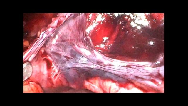 Hernioplasty TAPP (лапароскопическая преперитонеальная герниопластика)