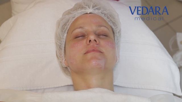 Peeling głęboko złuszczający TCA 15%- Vedara Medical смотреть онлайн