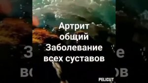 ?Мощная матрица Гаряева .Исцеление от общего артрита всех суставов и позвоночных дисков.