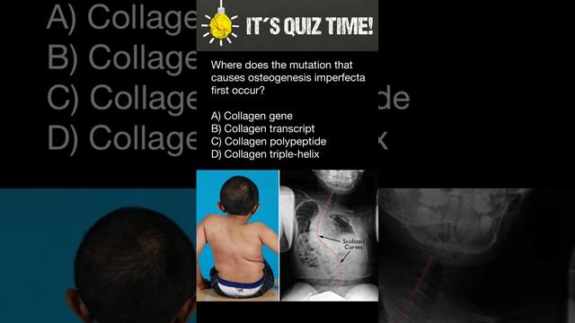 Osteogenesis imperfecta смотреть онлайн