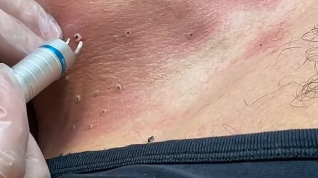 Удаление папиллом диодным лазером 980 нм смотреть онлайн