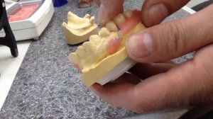 Протезы с фиксациям пилотом и капронеовим кламером