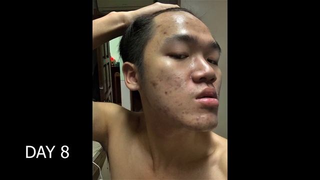 Acne update (One month on doxycycline) смотреть онлайн