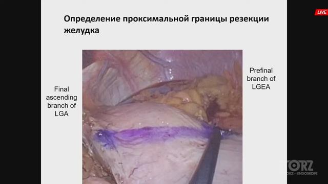 Круглый стол. Онкологический радикализм vs хирургическая безопасность смотреть онлайн