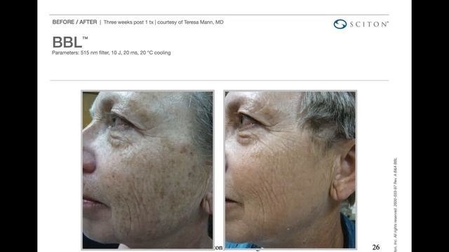 The Art Of The Photofacial W/ BBL & Forever Young BBL - 2020 Beauty Expo