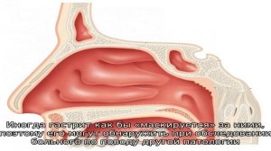 Что такое субатрофический гастрит?