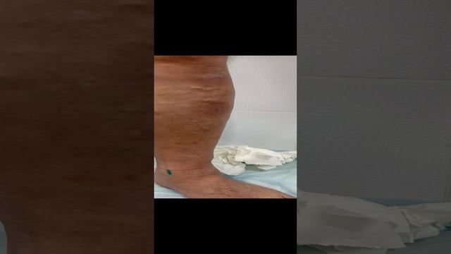 Переделываем ногу после неудачной операции по удалению варикоза лазером. Флеболог. Флеболог Москва смотреть онлайн