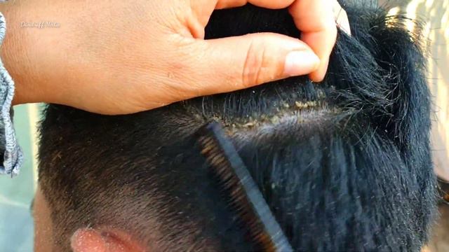 Best Dandruff Scratching On My Brother's Head #278 смотреть онлайн