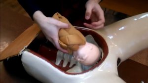 Биомеханизм родов при переднем затылочном предлежании