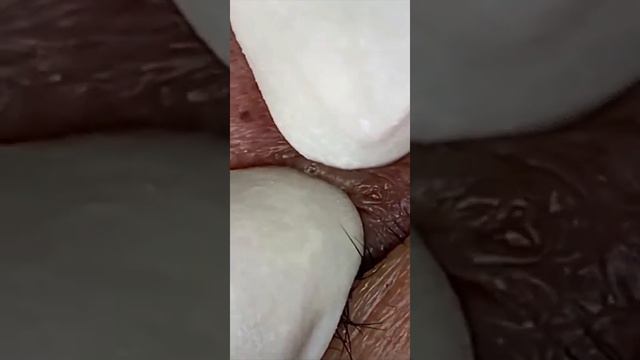 Best Pimple Remover - Pimple Popping At Home | How To Get Rid Of A Pimple Poppers Popping 2022 Best