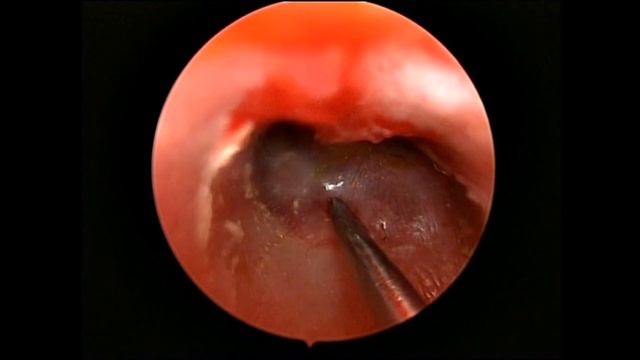Exudative Otitis Media Complicated By Mastoiditis (Exudative)