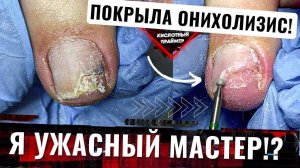 ЖЕСТКИЙ онихолизис ногтей?? Травма ногтя у постояшки, но мы пошли на риск и вот: БОКОВОЙ онихолизи
