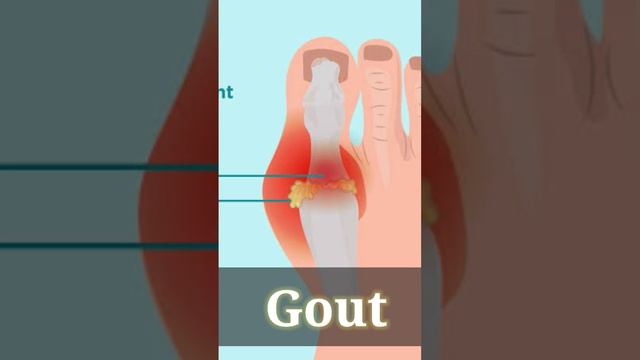 What is Gout? #gout #shortsfeed #viral #trending смотреть онлайн