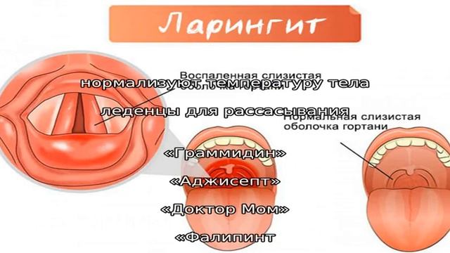 Как быстро вылечить ларингит в домашних условиях смотреть онлайн