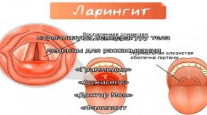 Как быстро вылечить ларингит в домашних условиях