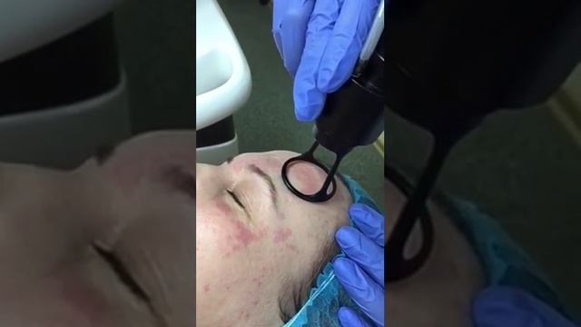 Фракционная лазерная шлифовка лица смотреть онлайн
