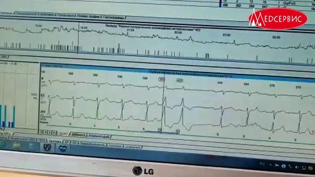 Холтер - что видно на анализе. Мониторирование и расшифровка холтера. Экстасистолия