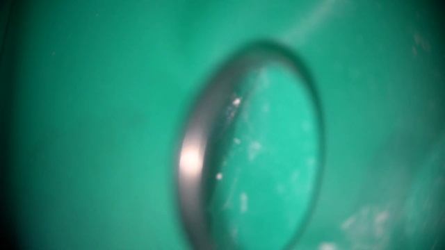 Апексификация - закрытие широкой верхушки корня с помощью МТА смотреть онлайн