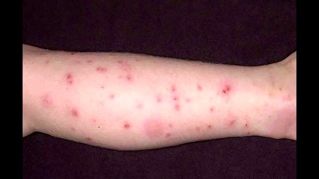 Укусы домашних клопов на человеке, лечение смотреть онлайн