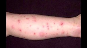 Укусы домашних клопов на человеке, лечение