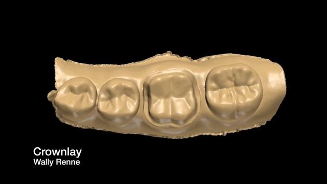 Posterior Tooth Preparations Inlay, Onlay, Crownlay And Crown