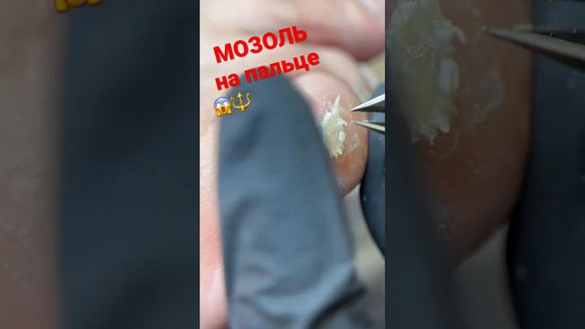 📌мозоль на пальце / обработка мозоли / кусачки для кожи #подологмосква #мозольнапальце #мозоль