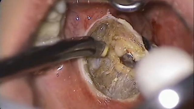 Coblation tonsillectomy смотреть онлайн