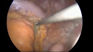 Лапароскопическая резекция сигмовидной кишки