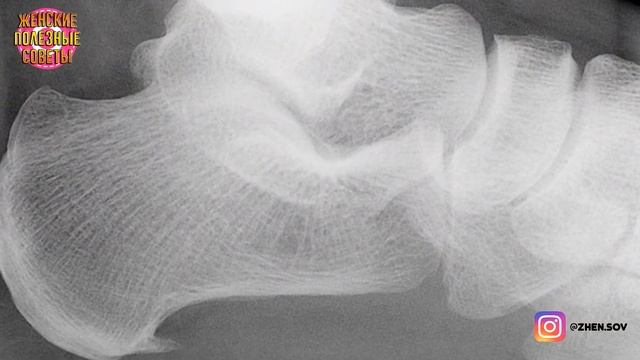 Избавляемся от пяточной шпоры с помощью этих простых и эффективных упражнений! смотреть онлайн